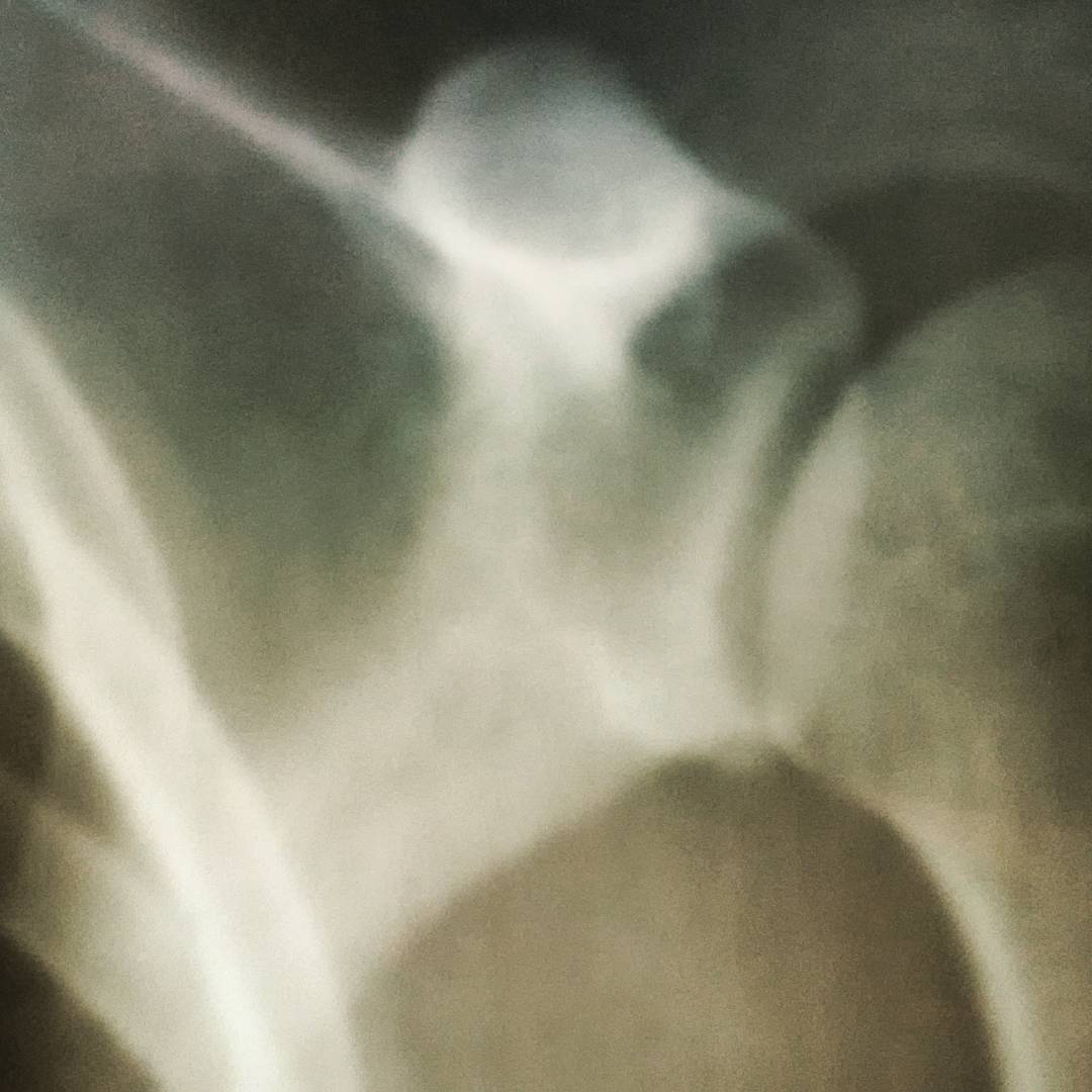 Fotka od Ferdika. 249/366: Ok, one more #injury this year after falling down from #boulder in NY. The good thing is that the shoulder is just bruised = no activity for 2-3 weeks. #xray, #bouldering, #climbing