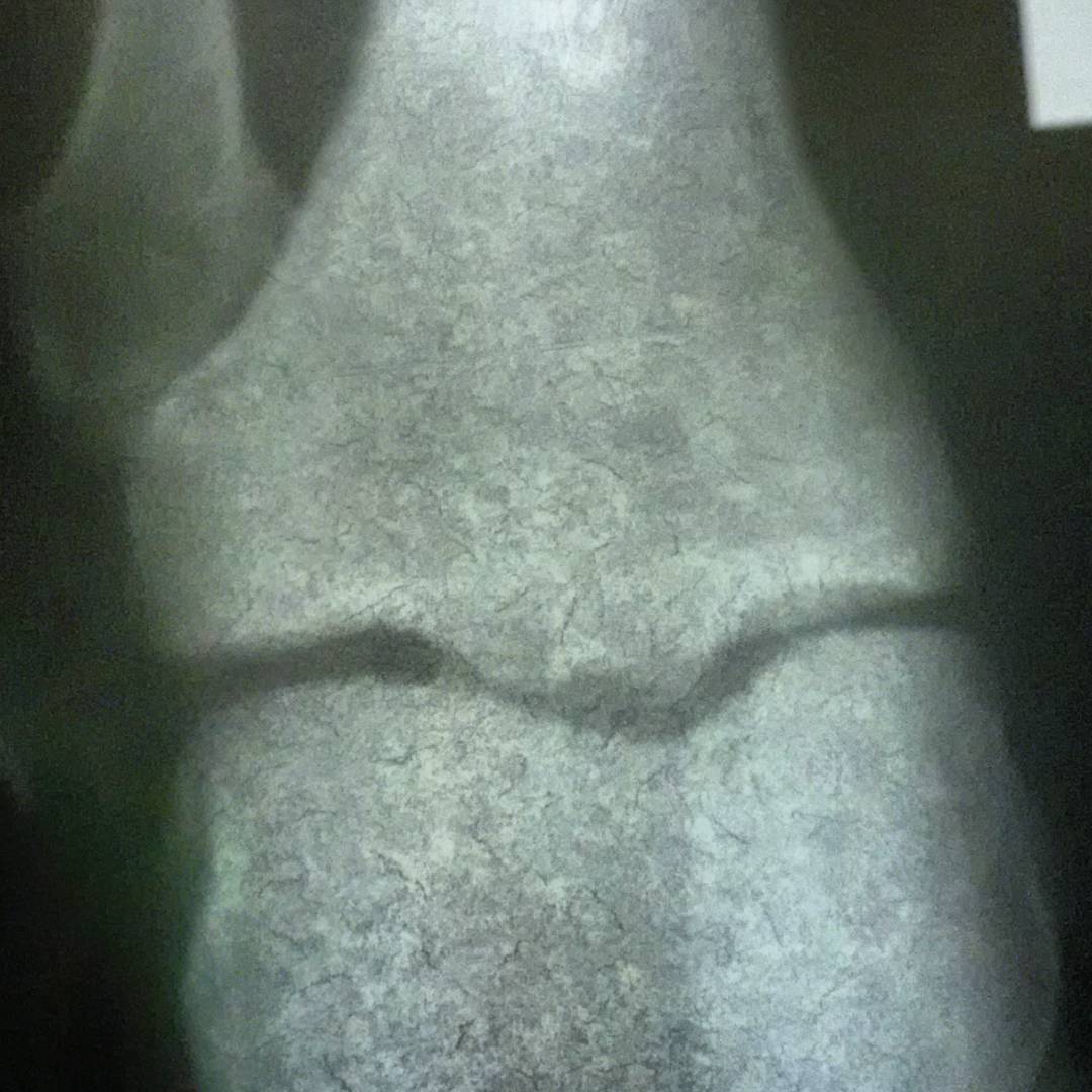 Fotka od Ferdika. 348/366: Is something wrong here? I will see in a minute. #knee, #injury, #hospital, #rtg, #bones, #xray